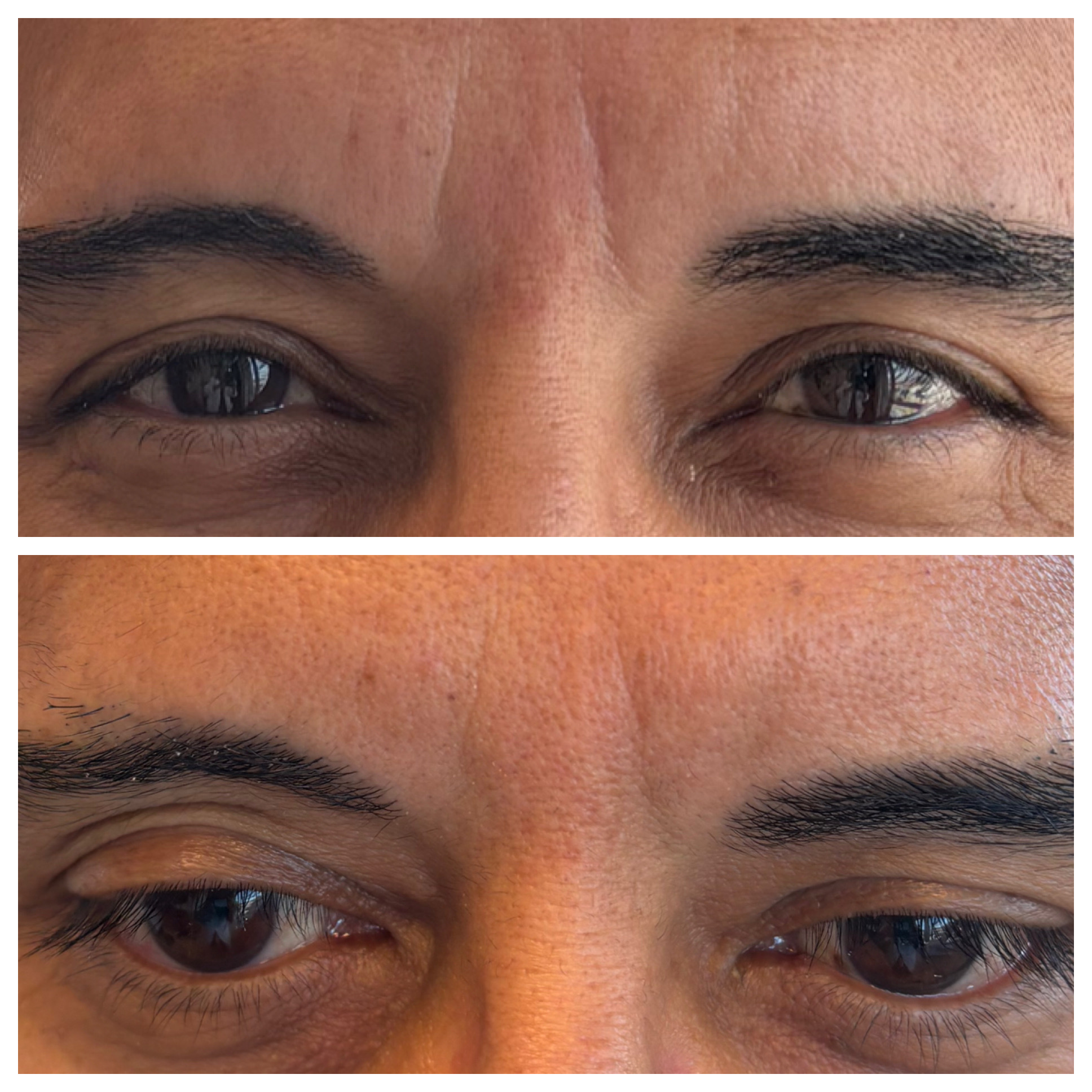 Before and after aesthetic treatments of eyes